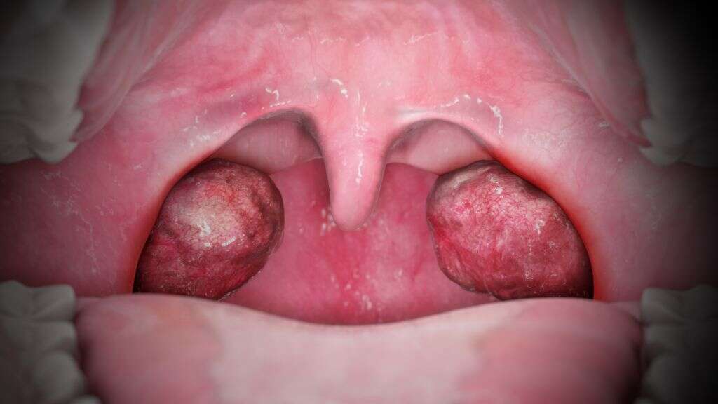 Tonsils