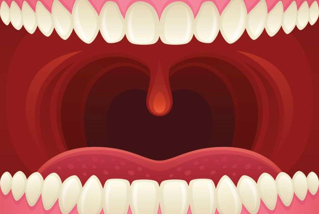 Tonsils