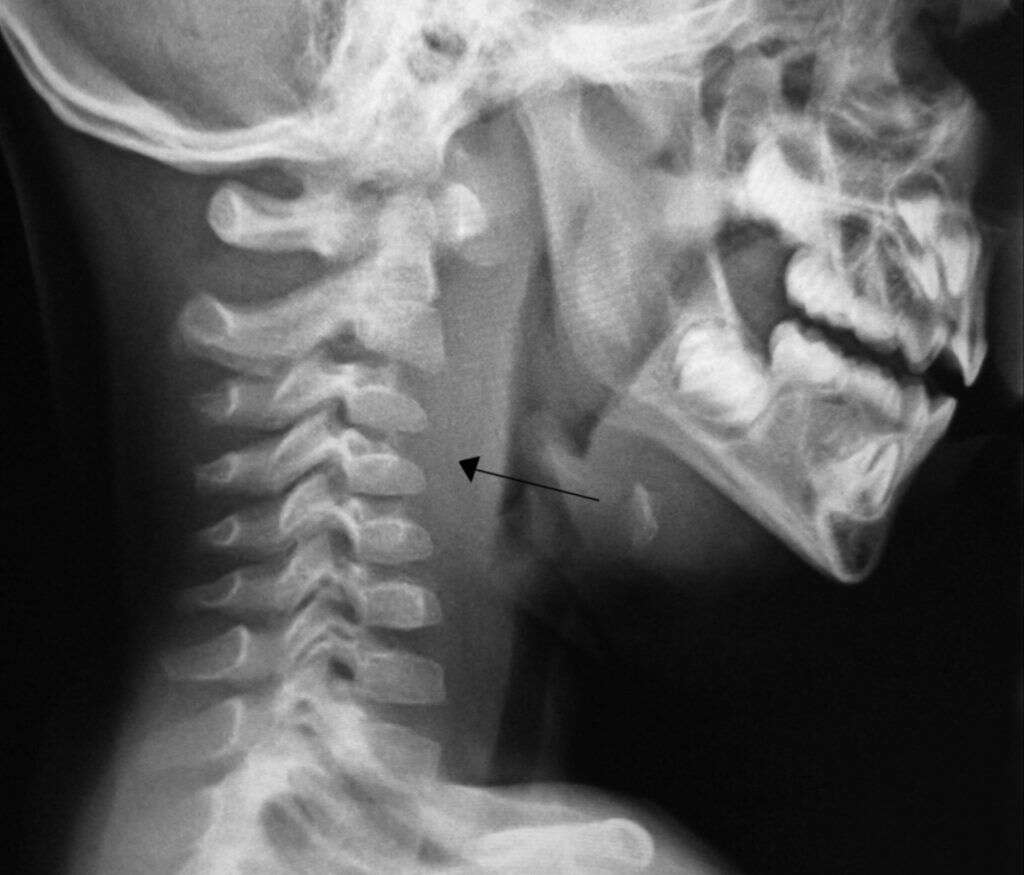 Tonsils