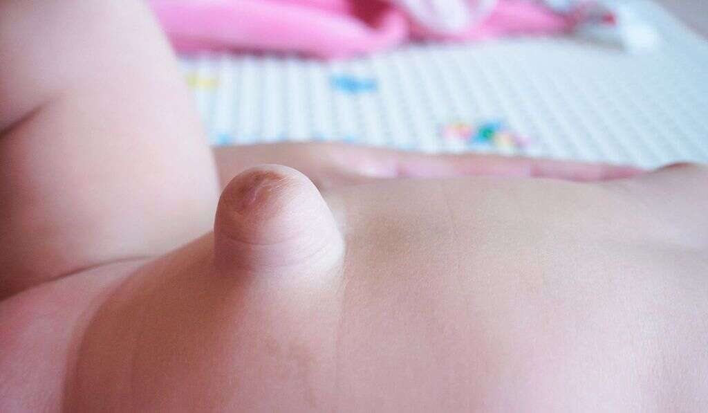 Hernia