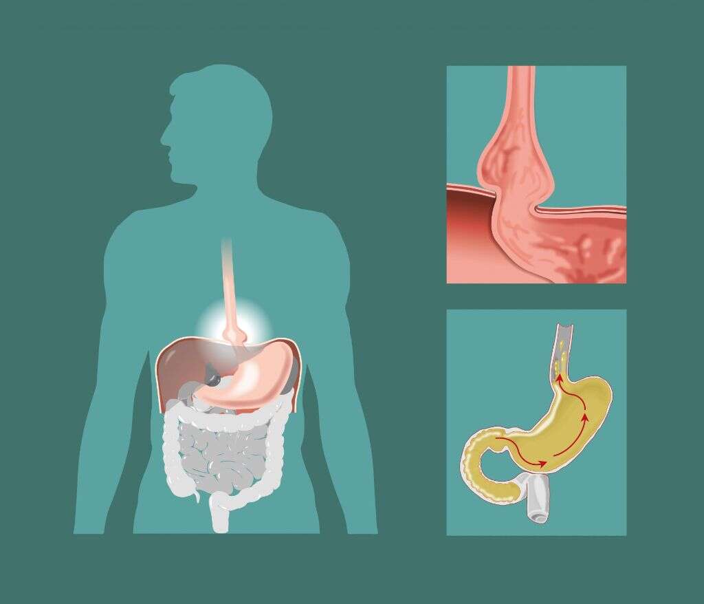 Hernia