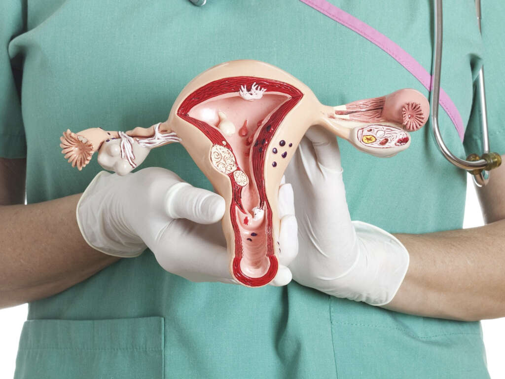 Ovarian Cyst