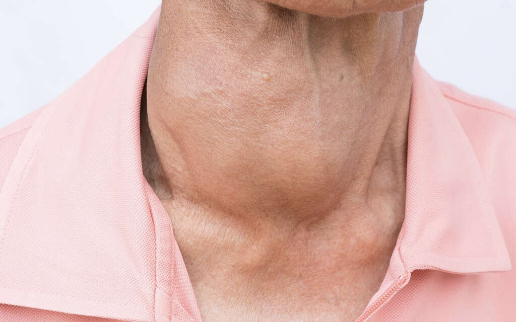 Thyroid