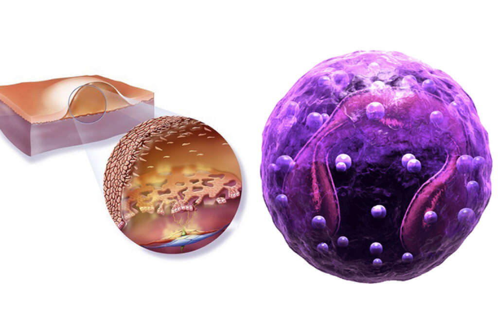 Bacterial Infection