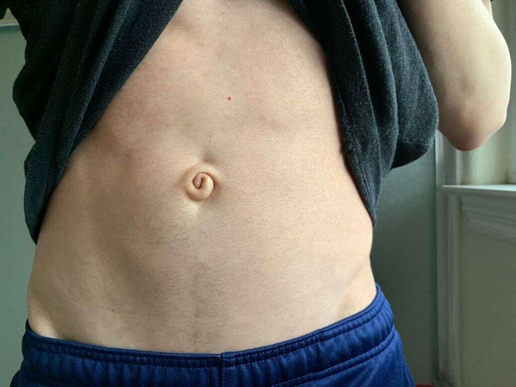 What Is a Belly Button Infection?