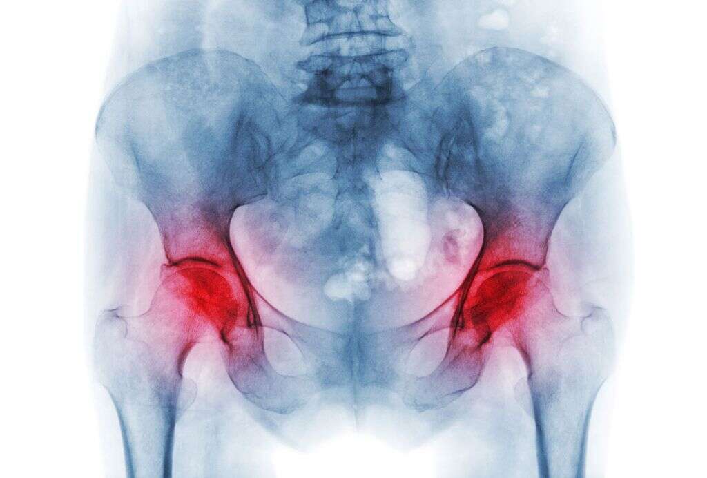 Bone Infection
