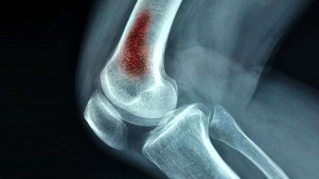 Bone Infection