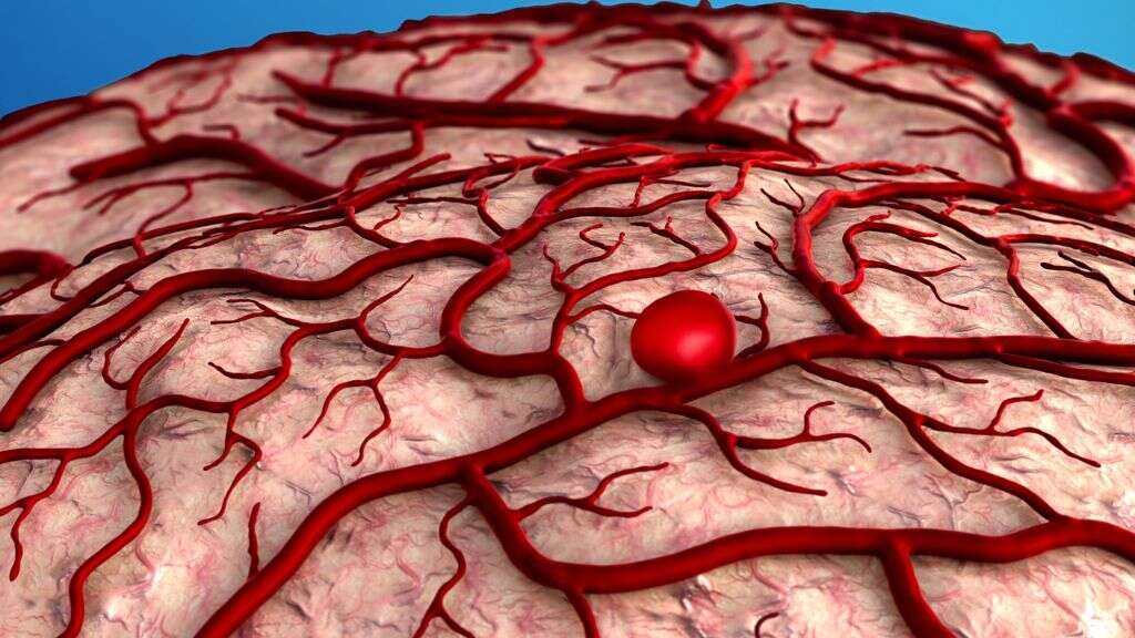 Brain Aneurysm