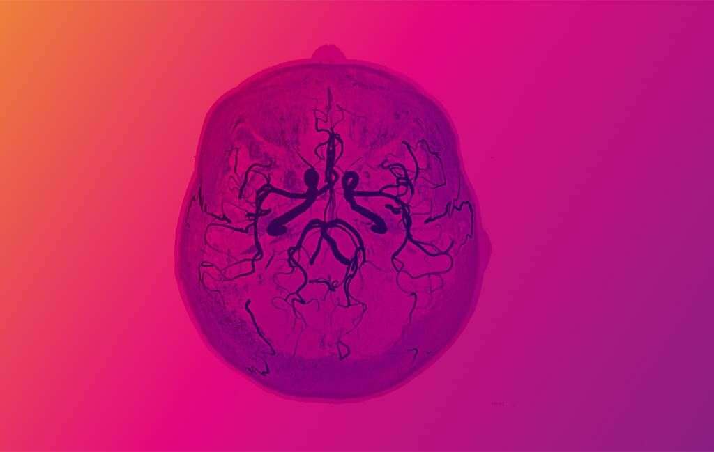 Brain Aneurysm