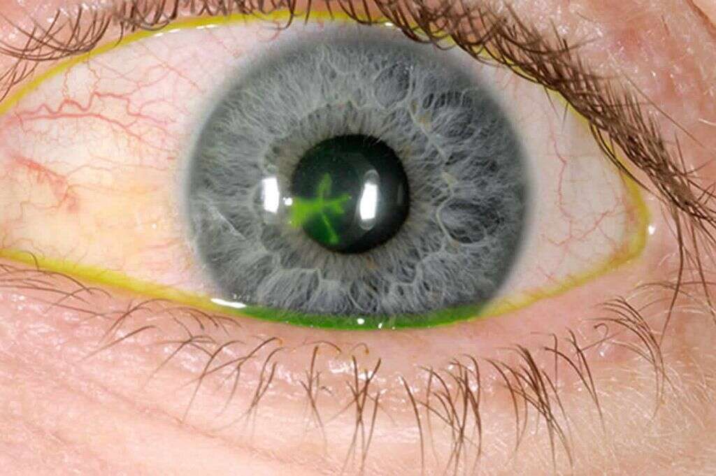 Corneal Ulcer