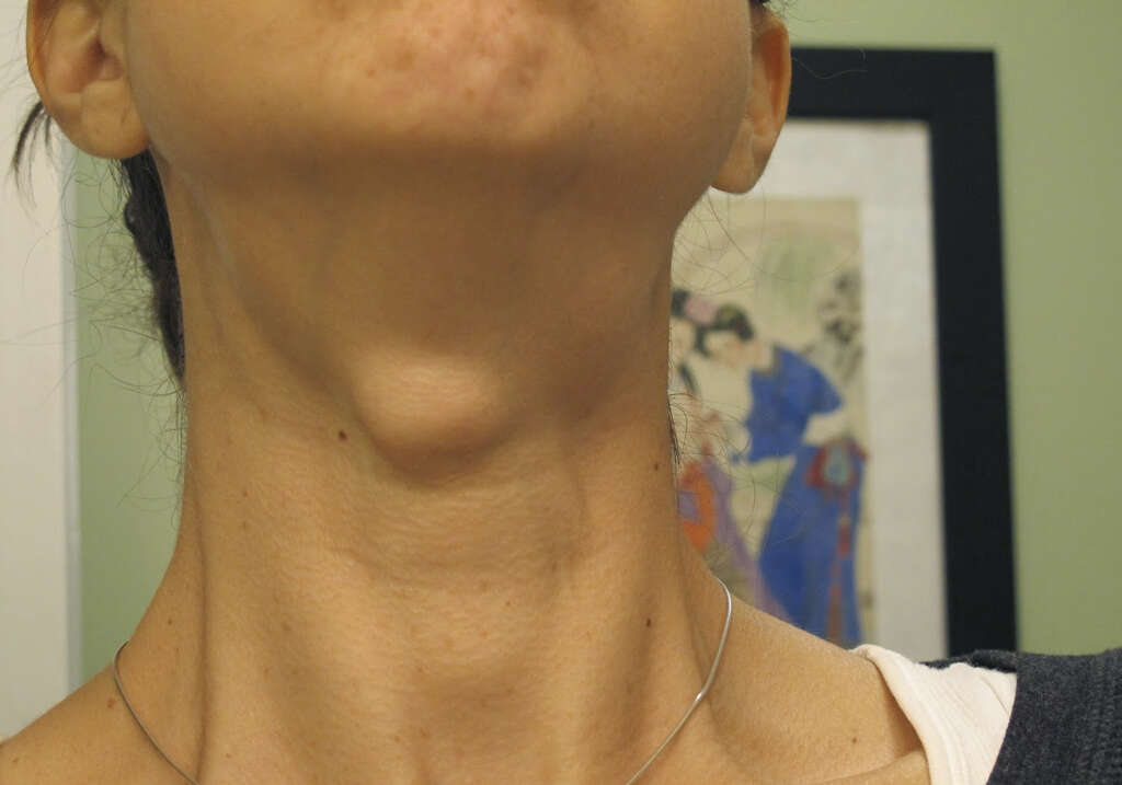 Cyst