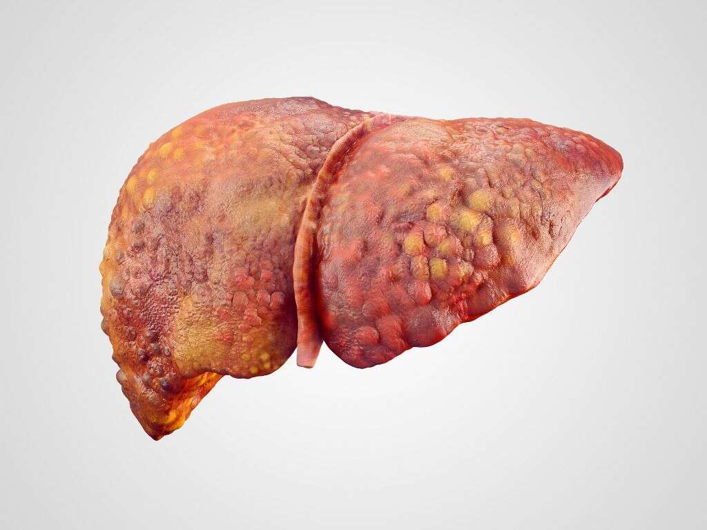 Fatty Liver