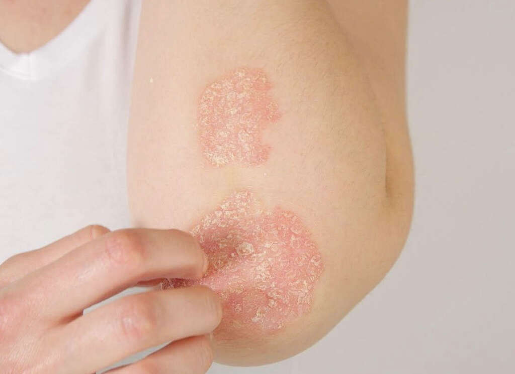 Fever Blister