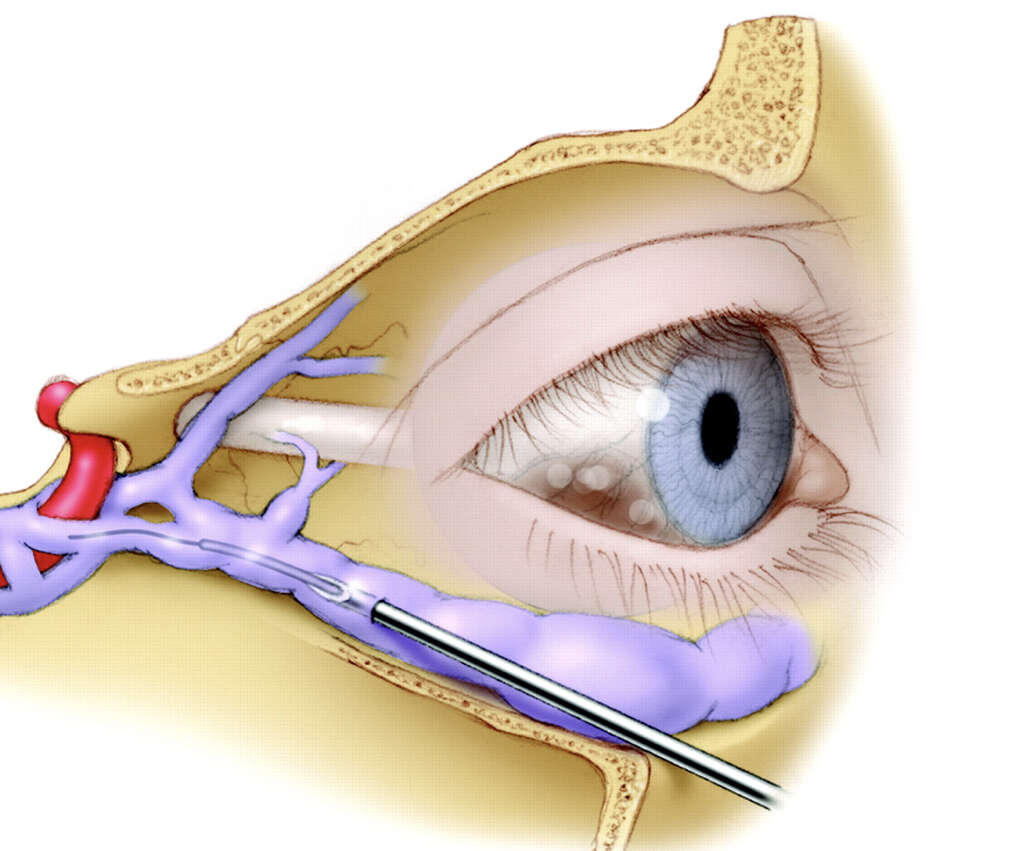 Fistula