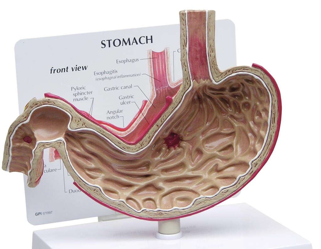 Gastric Ulcer