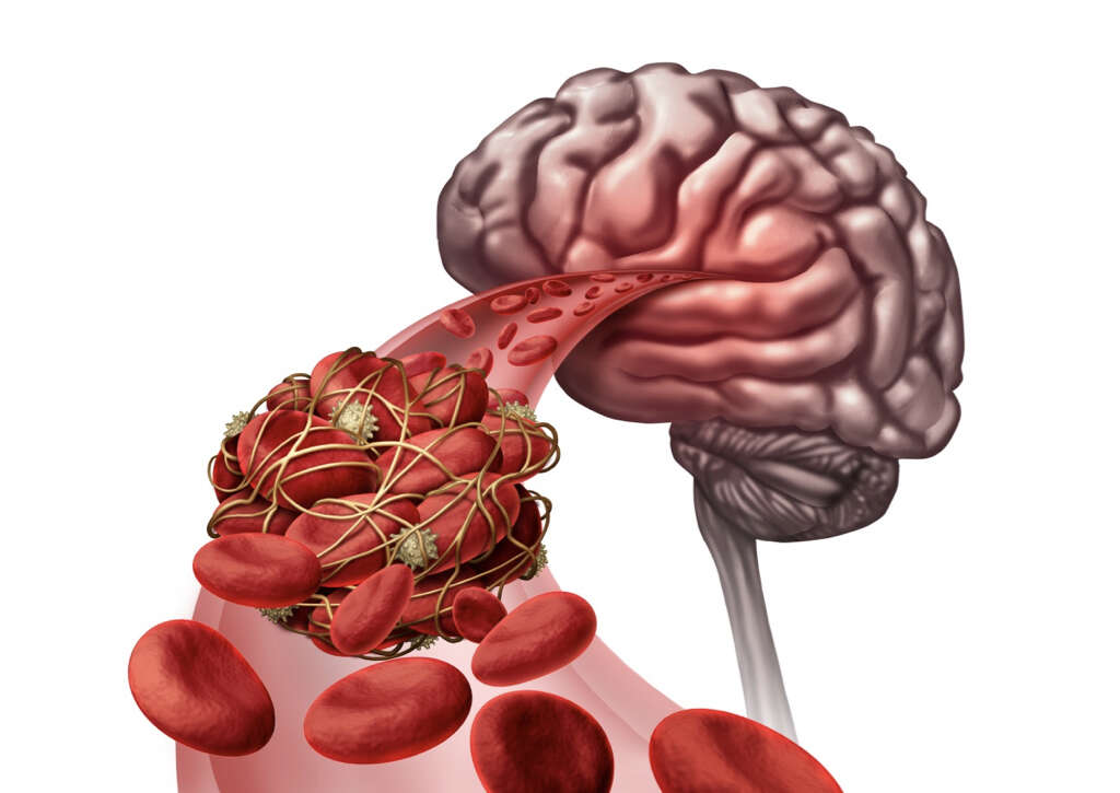 Giant Cell Arteritis