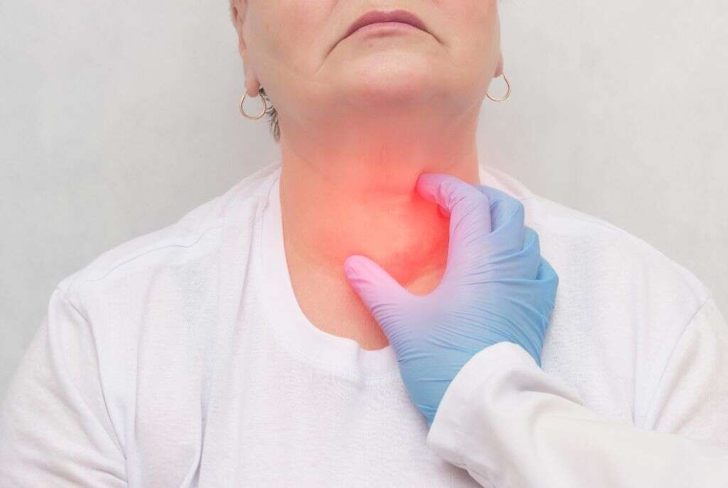 Goiter