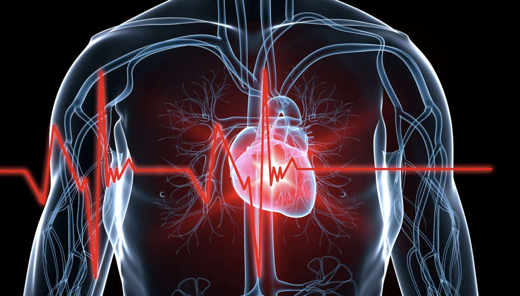 Heart Attack