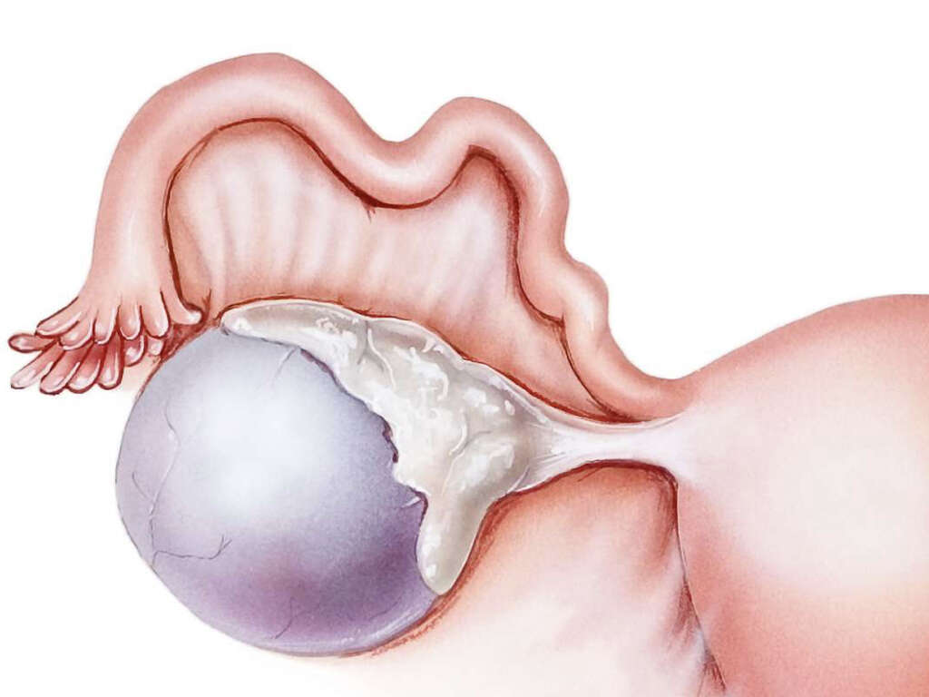 Hemorrhagic Cyst