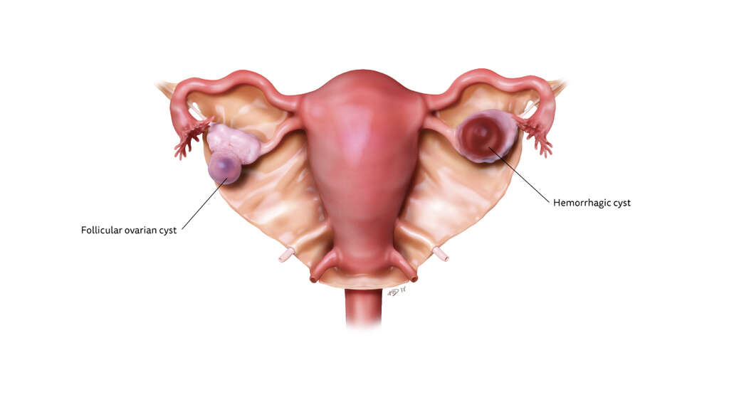 Hemorrhagic Cyst