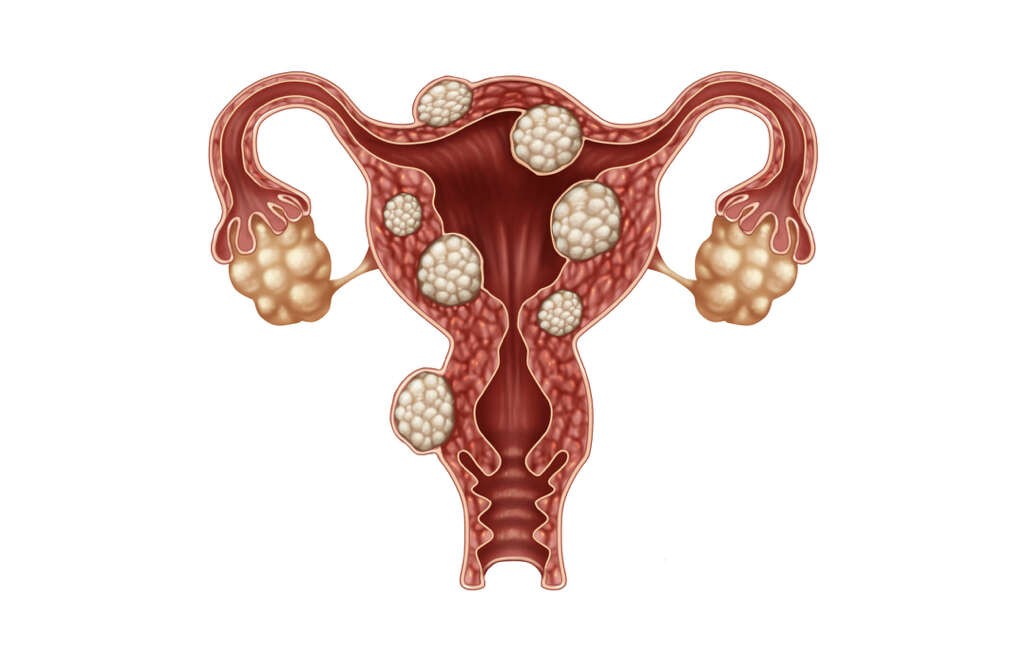 Hemorrhagic Cyst