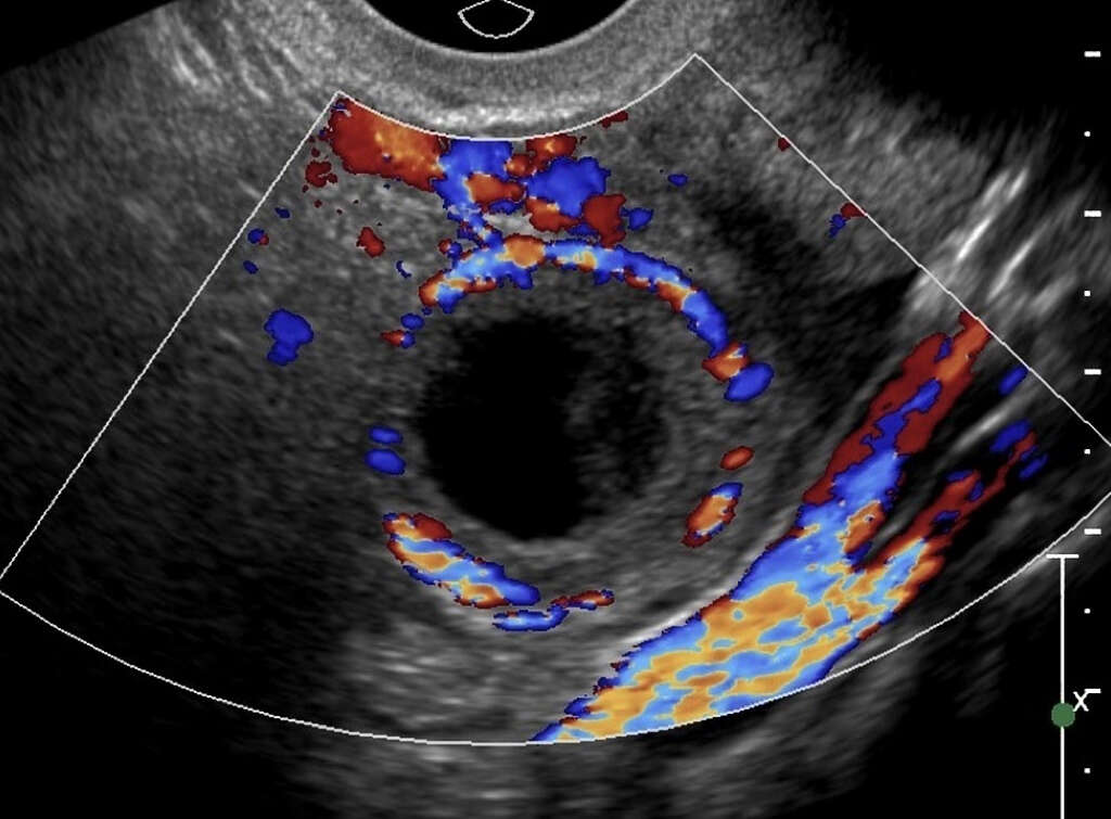 Hemorrhagic Cyst