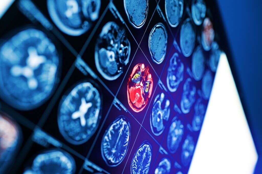 Hemorrhagic Stroke