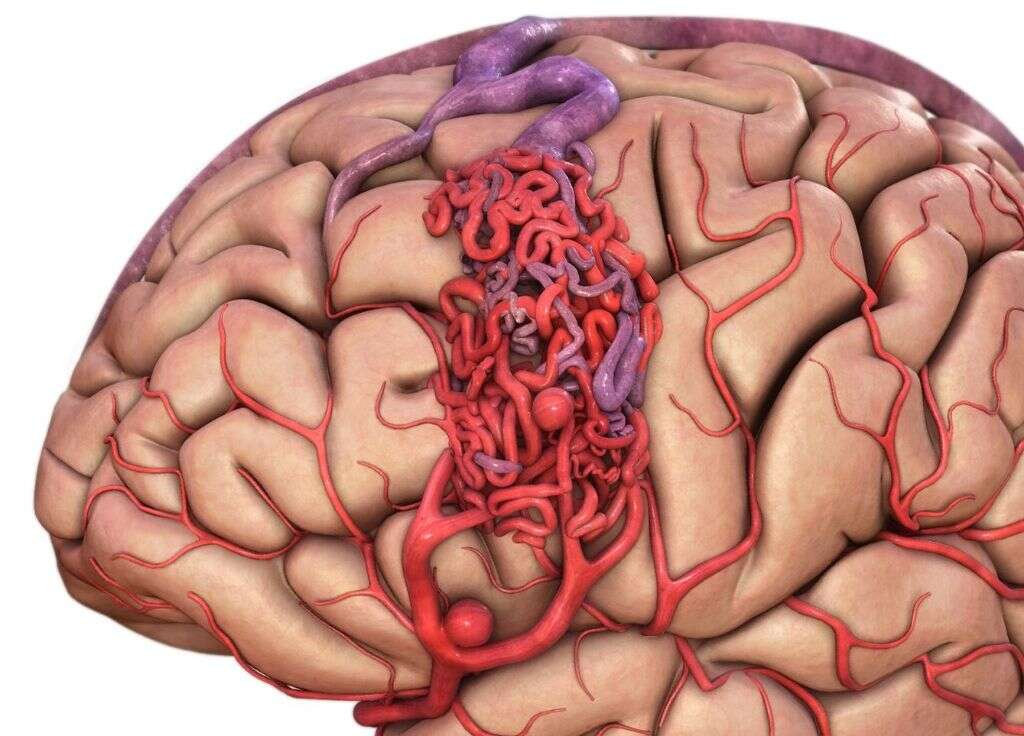 Hemorrhagic Stroke