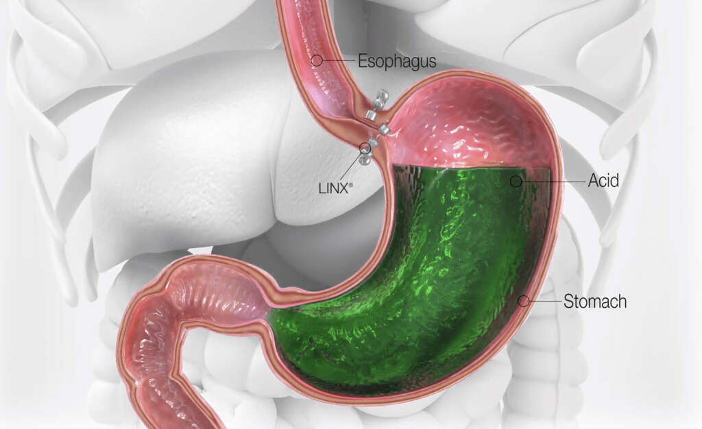 Hiatal Hernia