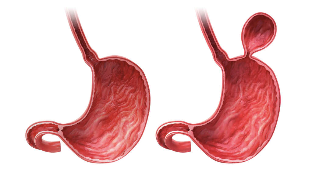Hiatal Hernia