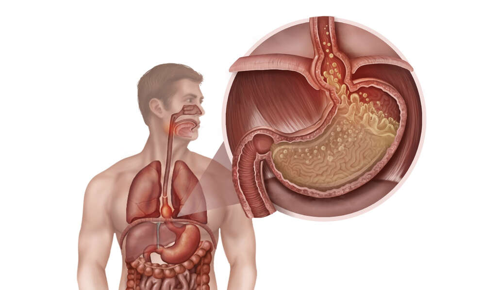 Hiatal Hernia