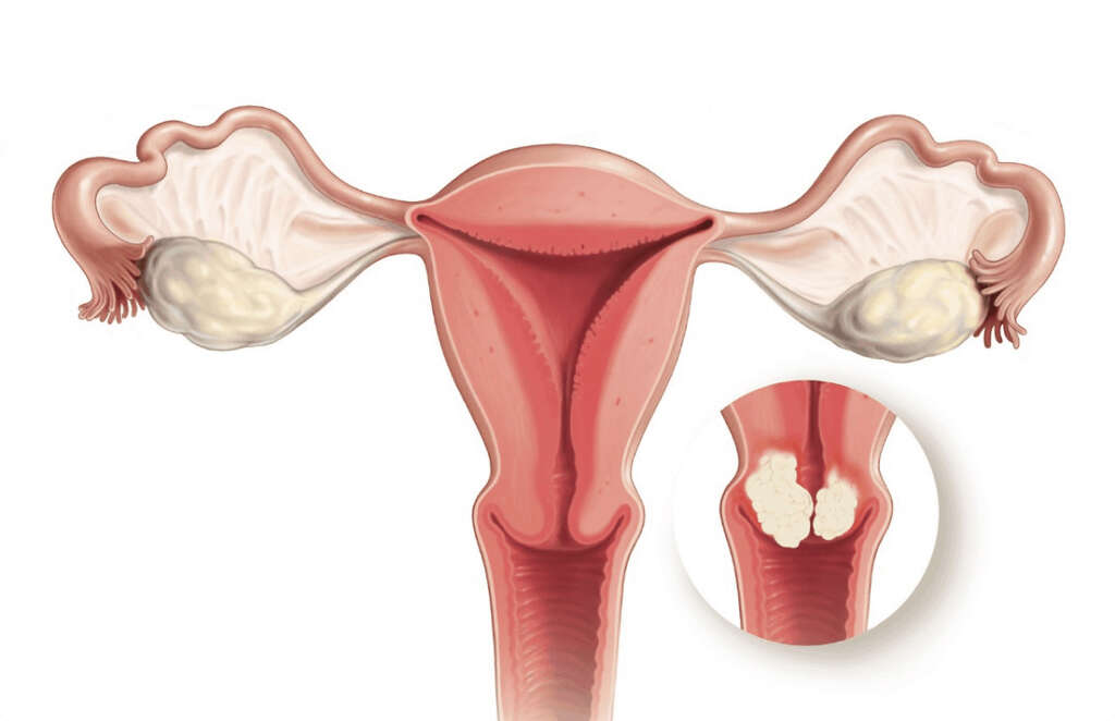 Human Papillomavirus Infection