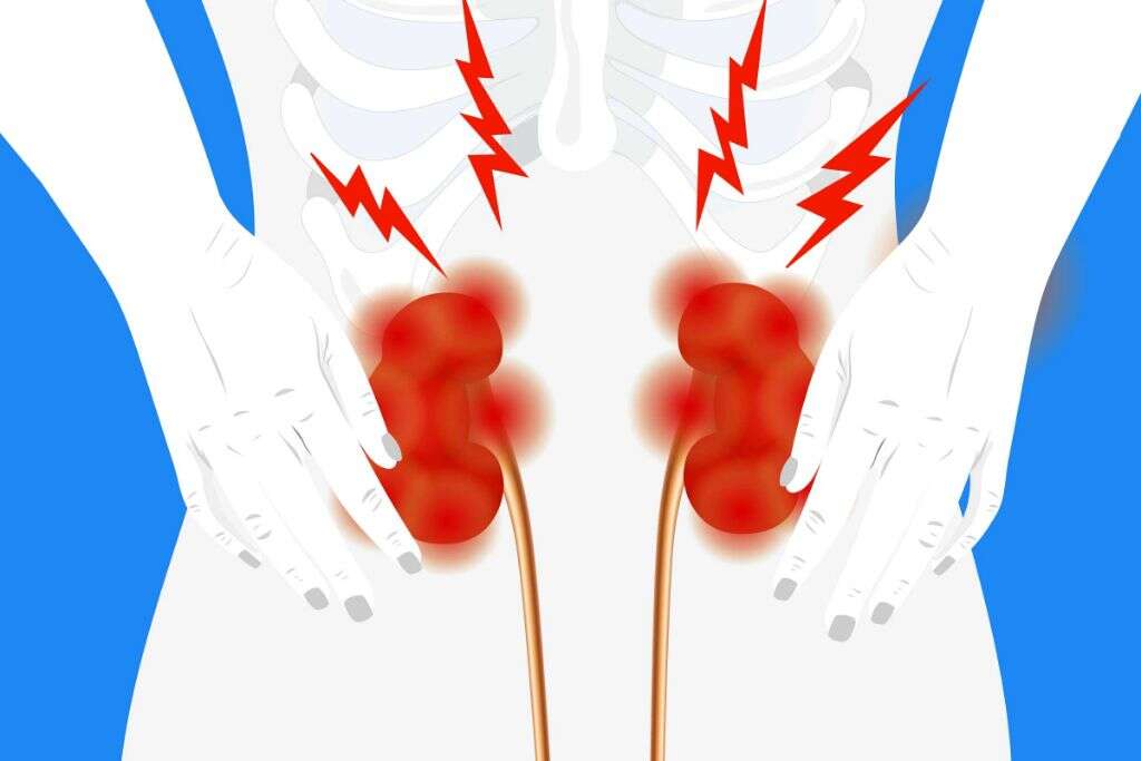 Kidney Infection