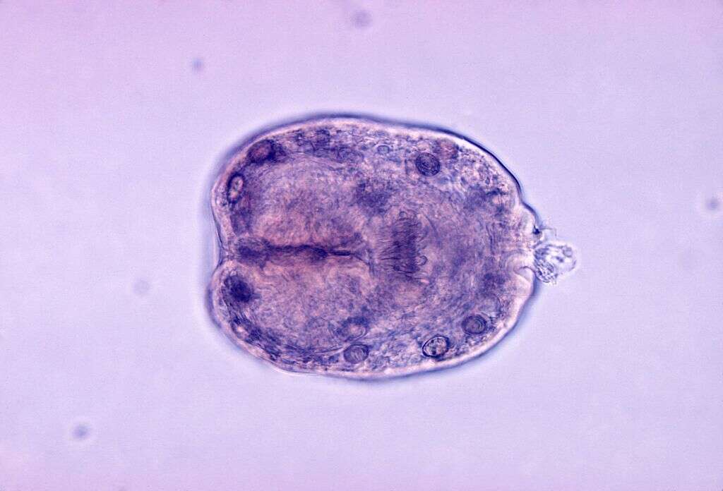 Liver Cyst