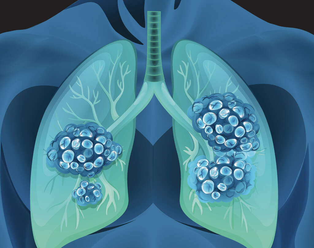 Lung Nodule