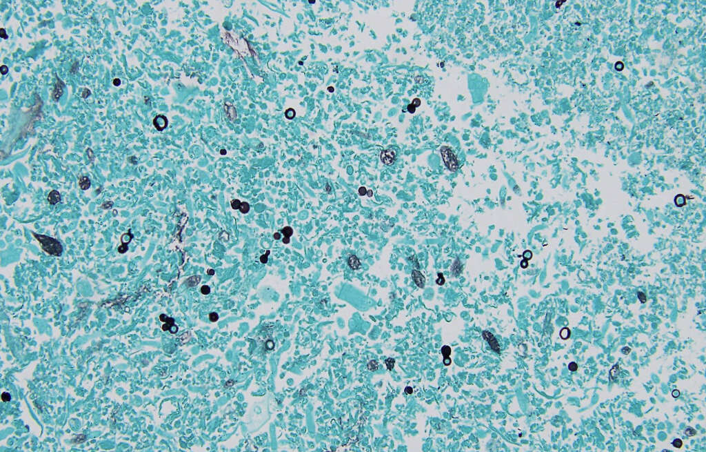 Lung Nodule