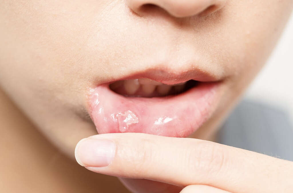 Mouth Ulcer