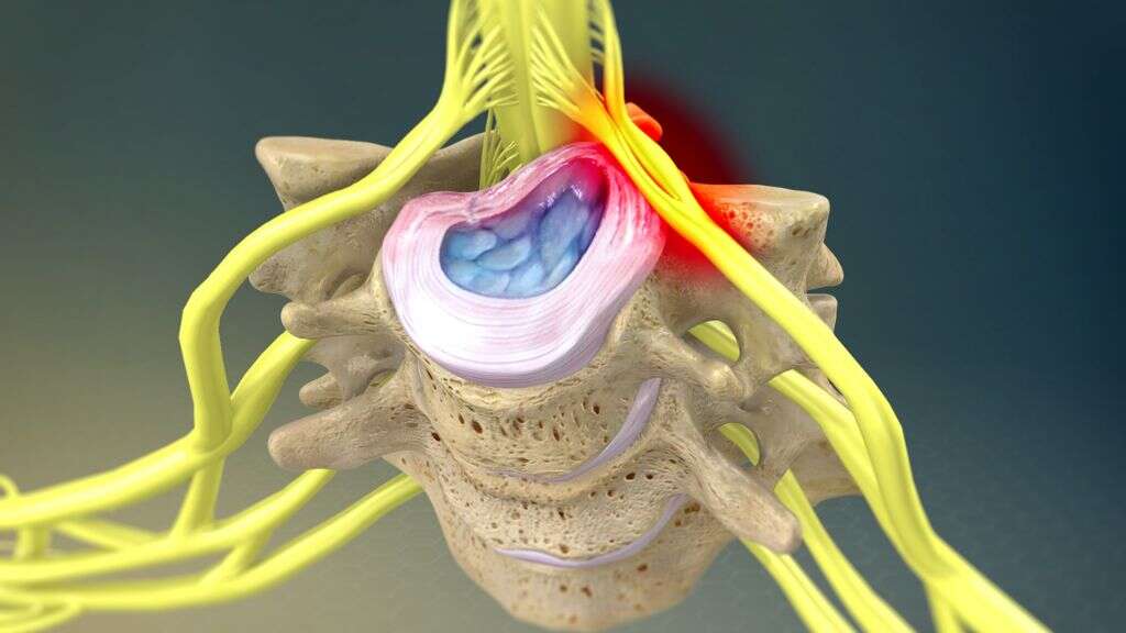 Myelopathy