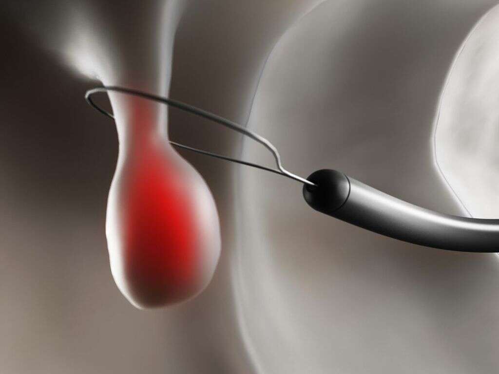 Polyp