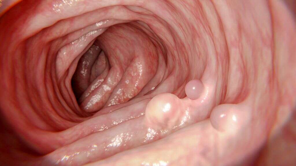 Polyp