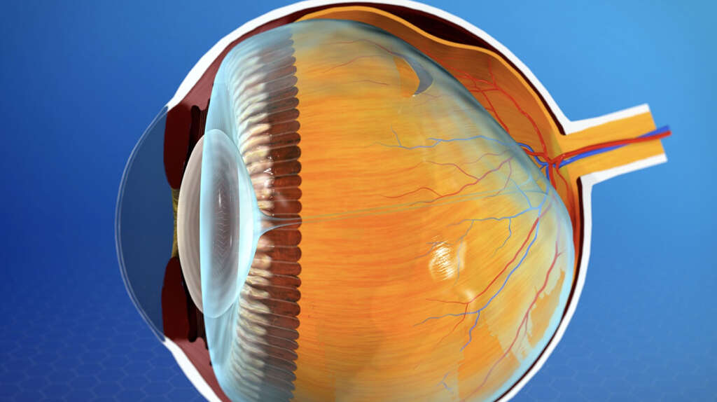 Posterior Vitreous Detachment