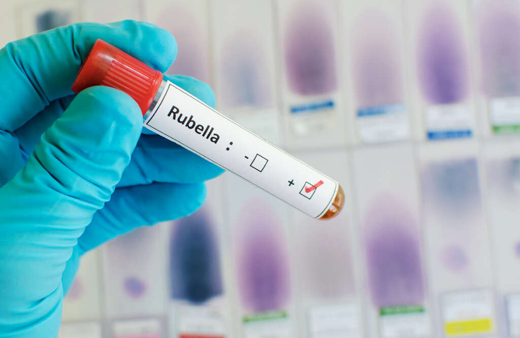 Rubella