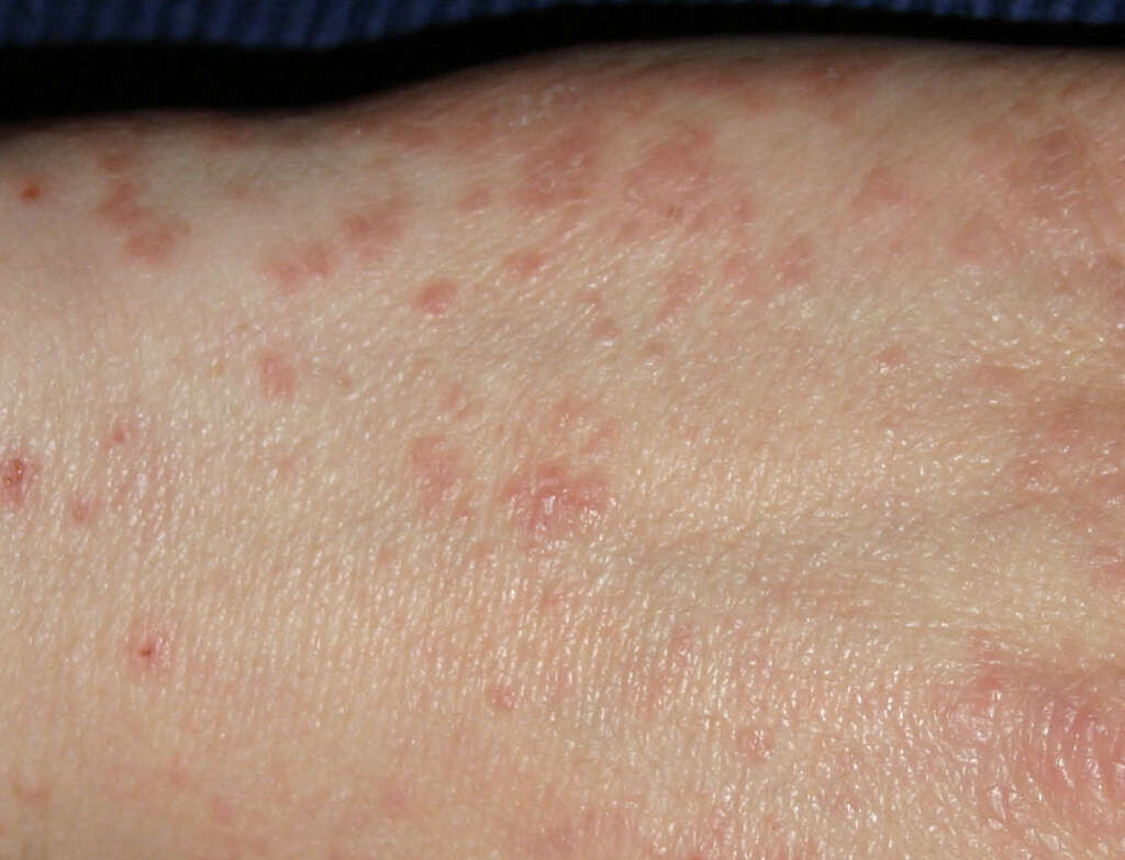 Scabies Rash