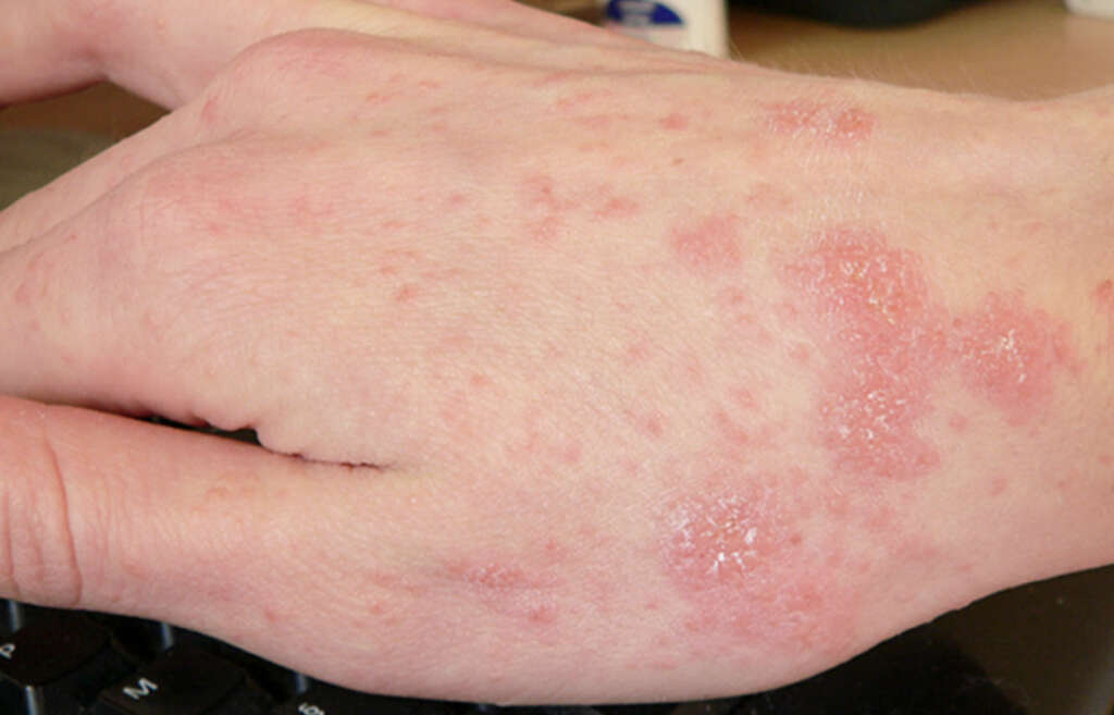 Scabies Rash