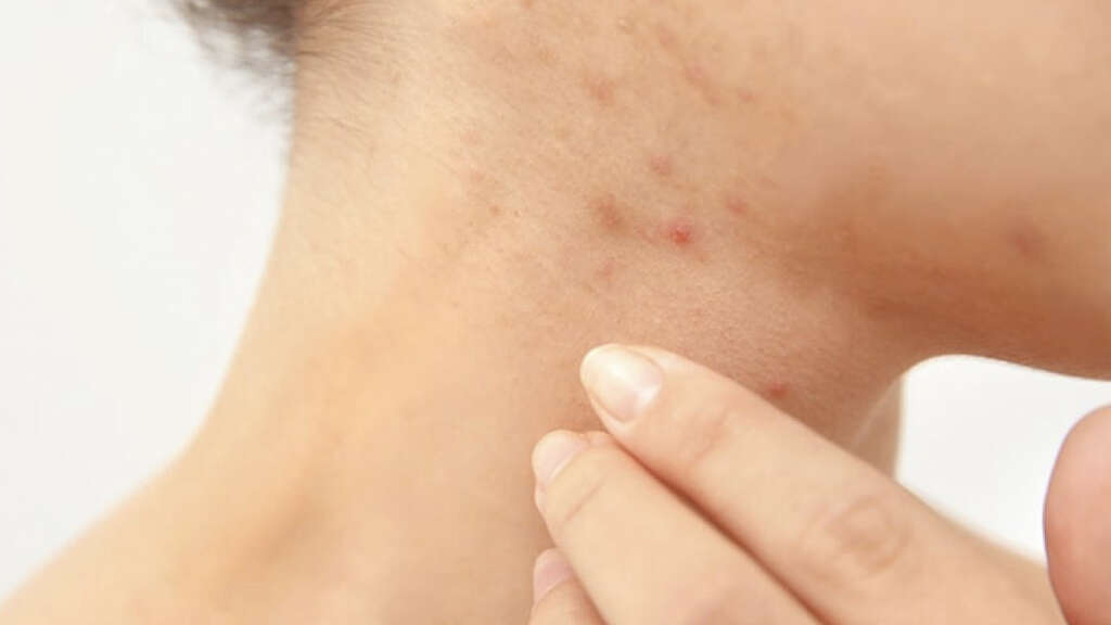 Scabies Rash