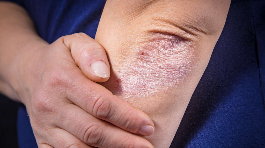 Scabies Rash