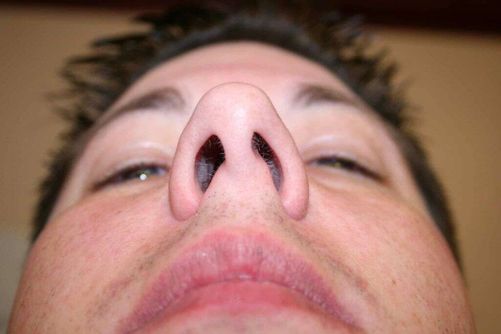 Sinus Infection