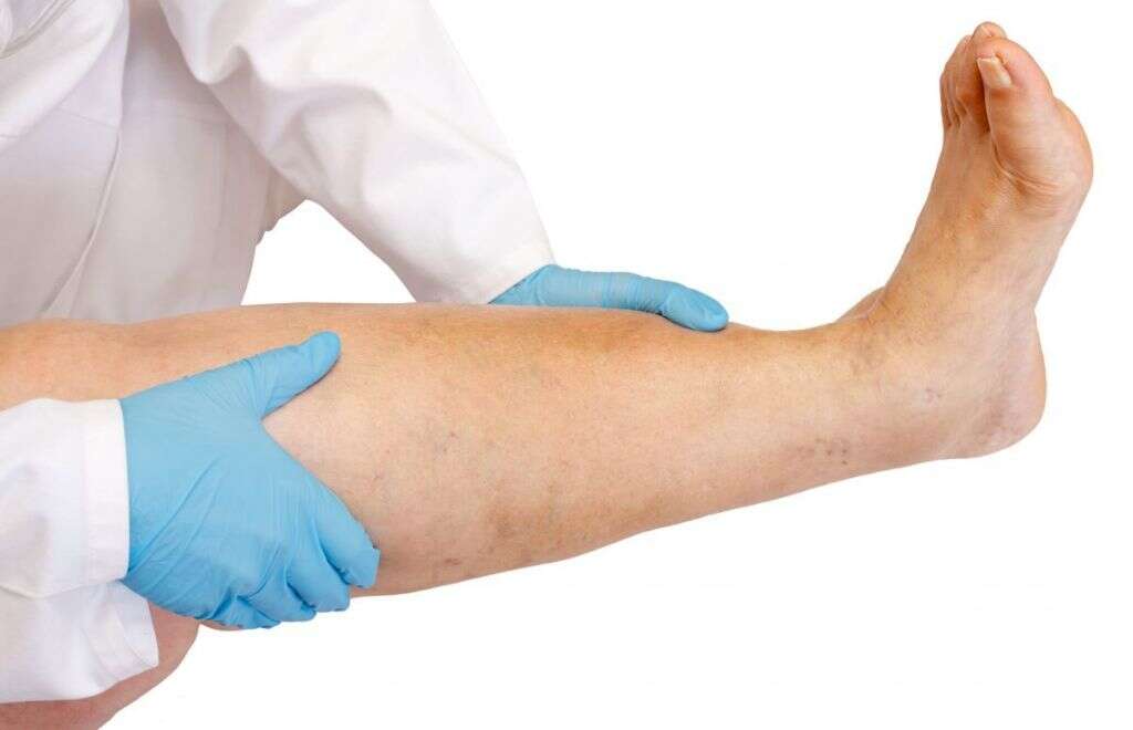 Staph Infection