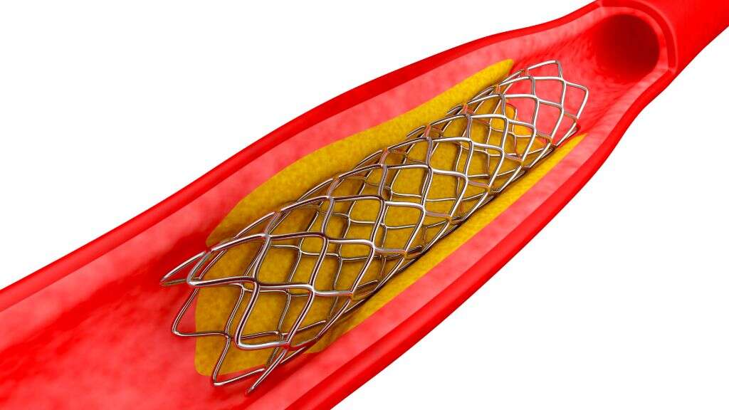 Stent