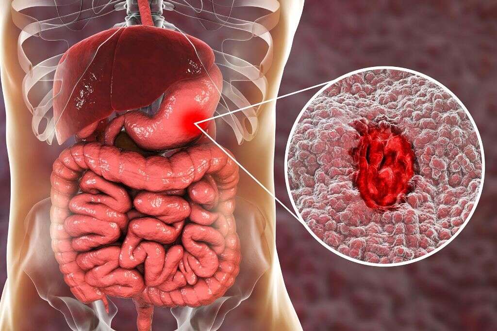 Stomach Ulcer